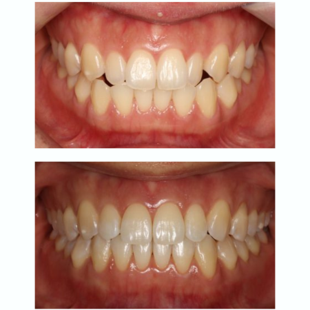 מרפאת שי סמייל- יישורי שינייים בשיטת אינויזיליין