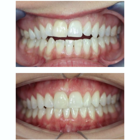 מרפאת שי סמייל- יישורי שינייים בשיטת אינויזיליין