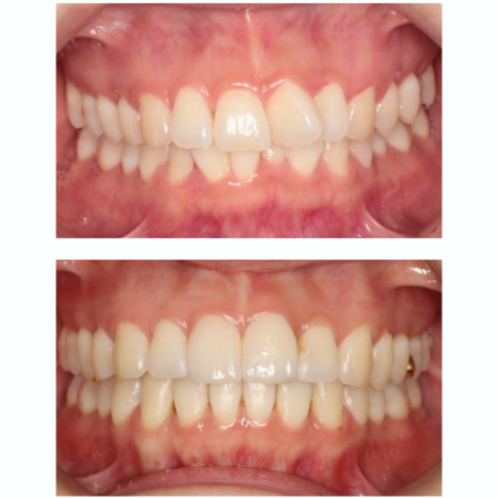 מרפאת Shay Smile - יישור שיניים בשיטת אינויזיליין