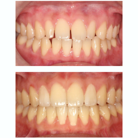 מרפאת Shay Smile - יישור שיניים בשיטת אינויזיליין